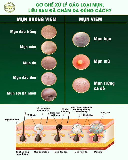 CƠ CHẾ XỬ LÝ CÁC LOẠI MỤN, LIỆU BẠN ĐÃ CHĂM DA ĐÚNG CÁCH?