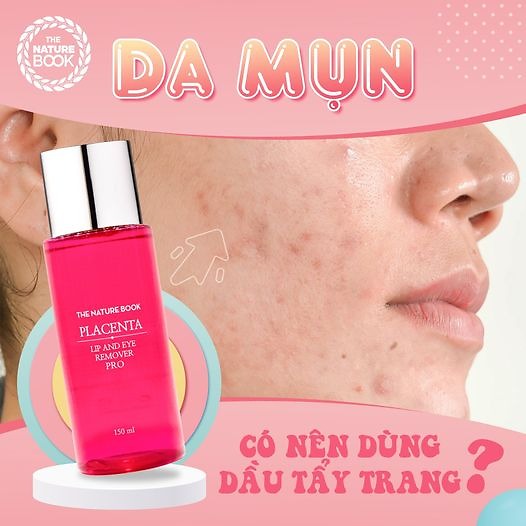 Da mụn có nên dùng dầu tẩy trang