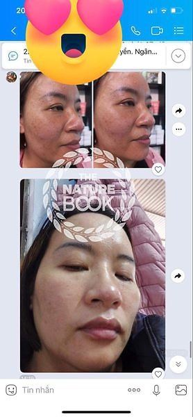Cô giáo mầm non cải thiện nám sạm sau 3 tuần sử dụng bộ trắng da sạch nám Nature Book